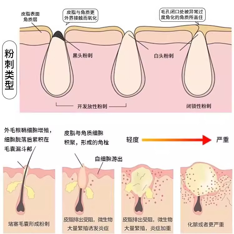 九鑫清热暗疮丸：痘痘界的“救火队长”-皮脂汗腺-淘宝好物网