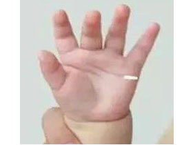 小儿推拿穴位之掌小横纹穴 化痰止咳