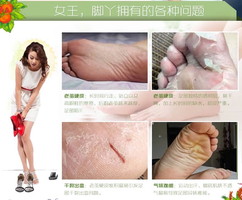 Cà chua pie chân kem dịu dàng chân tẩy tế bào chết chống khô chân kem sửa chữa 80 gam dưỡng ẩm dưỡng ẩm chân chăm sóc phim dưỡng da chân