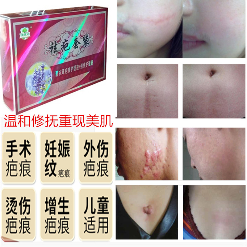 Surgical scar hyperplasia repair cream bump pimple scar fade melanin acne scar repair set