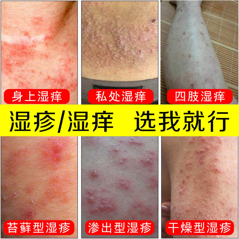 百草止痒膏老人皮肤干燥瘙痒全身外用药湿疹止痒去根脸痒过敏抑菌 百草止痒膏老人皮肤干燥瘙痒全身外用药湿疹止痒去根脸痒过敏抑菌