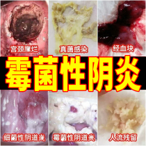 Private gel Candida bean curd residue female fungal female vaginal care maintenance itchy cold compress inflammation odor safflower