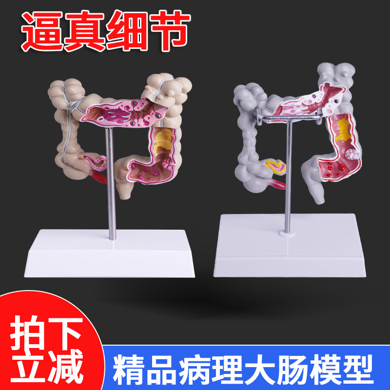 人体结肠病变模型 大肠病理模型肠道疾病 大肠模型大肠病变模型