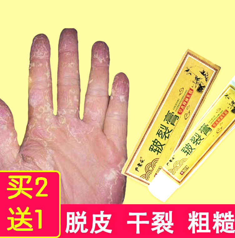Hand peeling seasonal repair cream palm Hand finger metaskin cracked dry and cracked skin Peel Popskin man with hands and feet