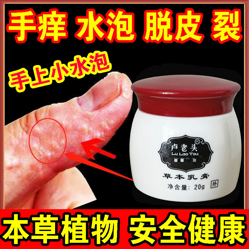 2022 Touch to restore palms, fingers, feet, feet, feet, dry, peeling, peeling, bursting, peeling, peeling cream, repair cream
