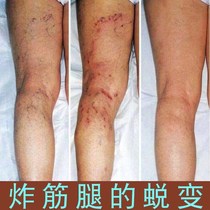 Caotang Jinmaikang health care gel earthworm legs men and womens green tendons raised old rotten leg paste