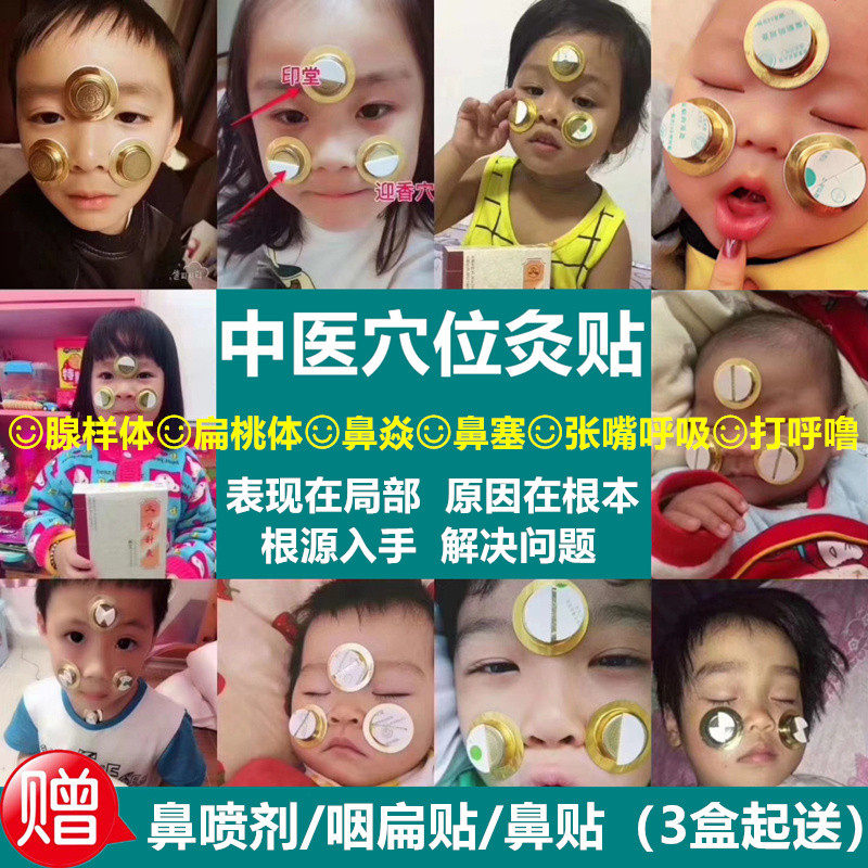 Children's adenoid hypertrophy Acupuncture points mouth pharyngeal tonsillar enlargement Face corrector Nasal spray conditioning artifact