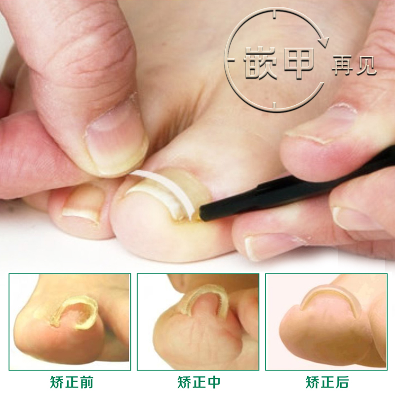 Life Vertical Nail Orthosis Orthopedic Toenail Correction Curl Correction Patch Orthothic Nail Patch Nail Groove