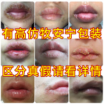 Mu Anning Lip Kangling mouth cheilitis Lip Cream Lip chapped lips mouth red itchy skin peeling blisters mouth corner repair