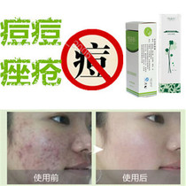 Enlever la partie supérieure de la fermeture Acne Flat Repair Cream men and women Youth pimple acne Full removal to face dark sore print