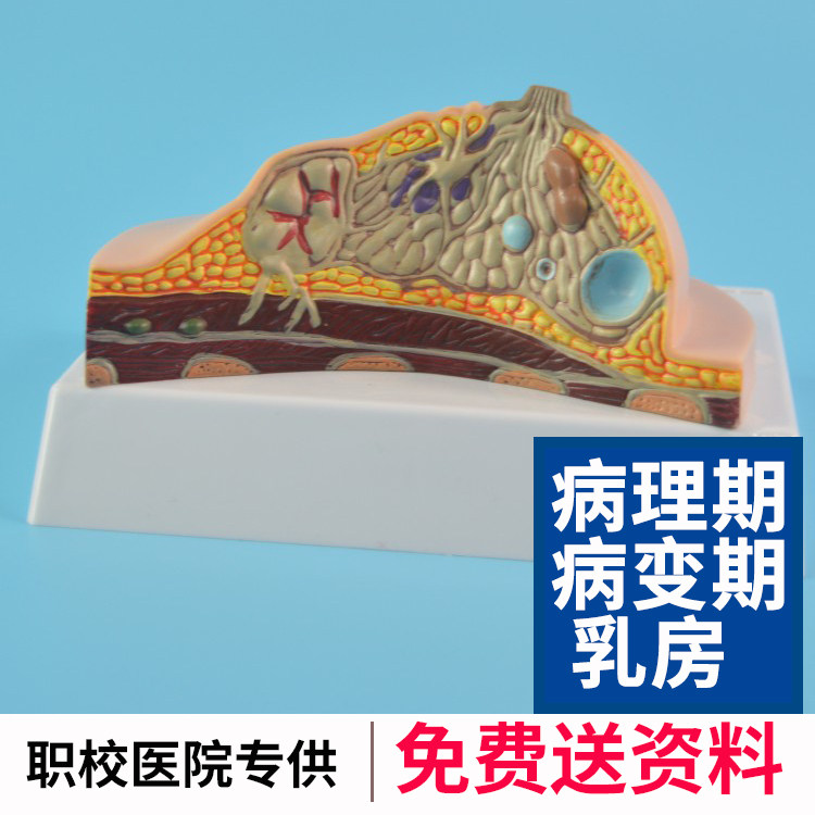 女性病理病变乳房模型解剖 女士病变乳房解剖模型 乳腺剖面模型
