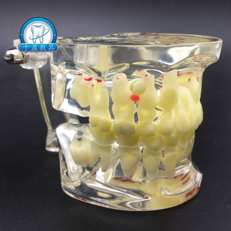 牙科口腔教学模型 儿童水晶病理模型 幼儿蛀牙龋齿乳恒牙交替包邮