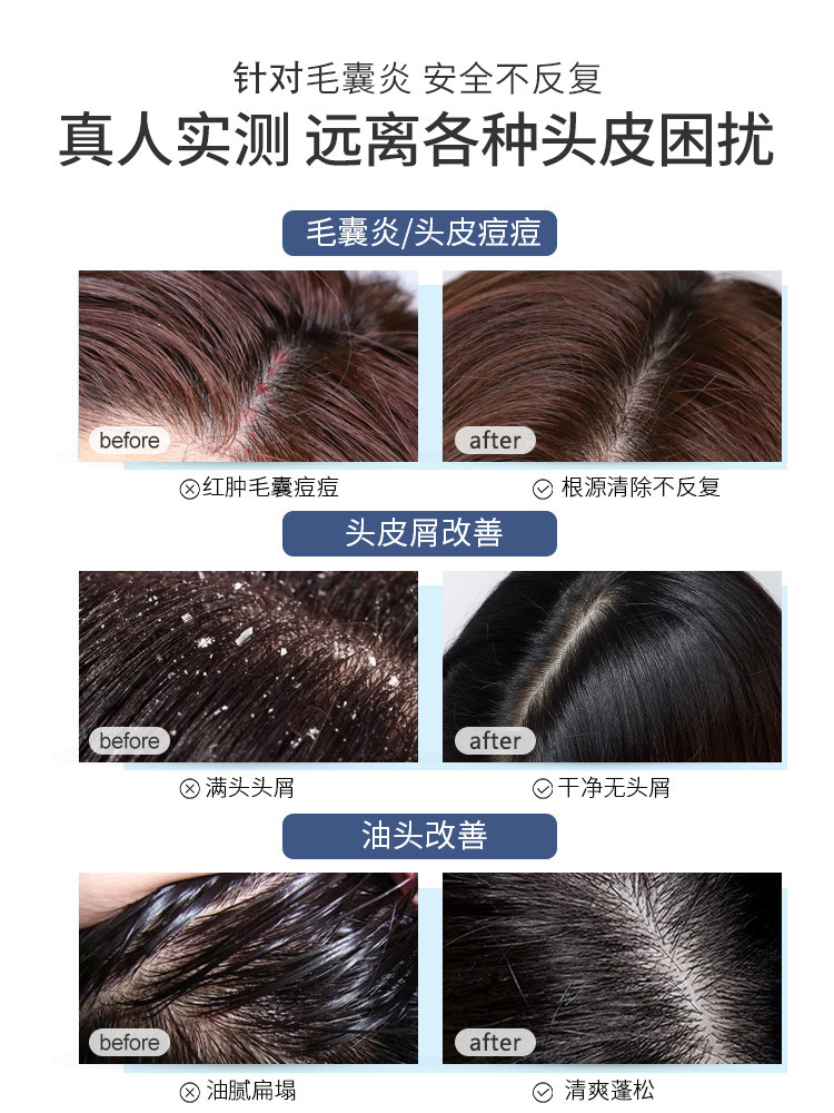 雄性禿治療：科学与希望的结合