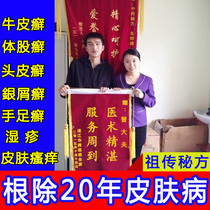 Cowhide topical skin special treatment for allergic itching urticaria femoral Moss ringworm root eczema antipruritic and root-removing ointment