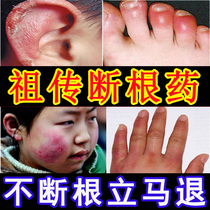 Frozen Sore Paste Antifreeze Injury Cream Winter Antifreeze Anti-Crack Freeze Hand Facial Ears Repair Child Hand Cream