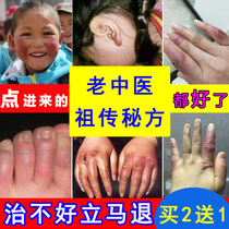 Frozen Sore Paste Antipruriant Freeze Cream of Swelling Frozen Feet Cream Hand Foot Antifreeze Anti-Crack Treatment Hand Child Hand Cream