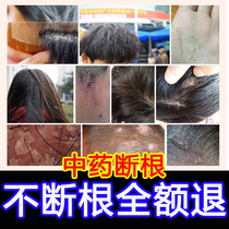 Head ringworm external to fungal infection psoriasis perspiration Sweat Herpes stock Ointment Silver Chip Special Effects Neurodermatitis to eradicate