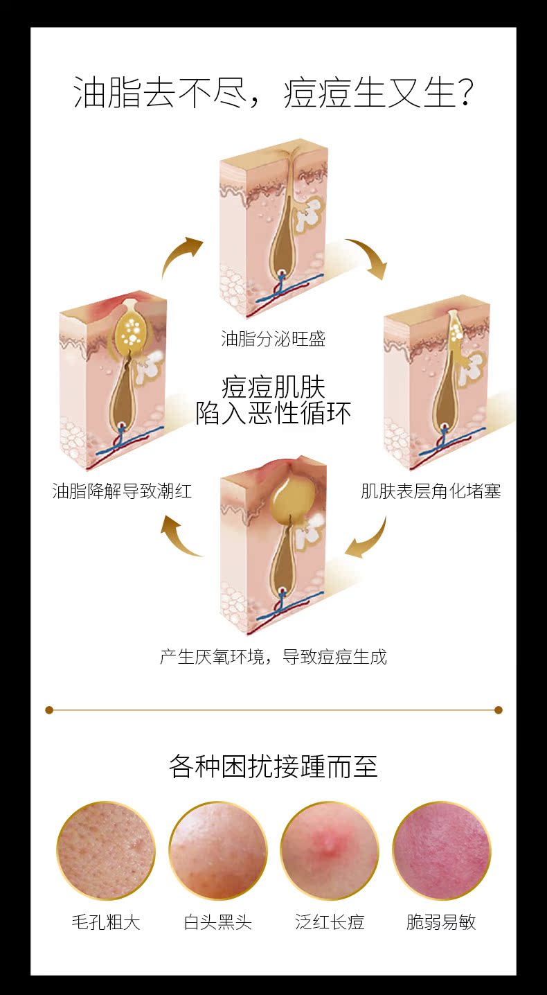 Mặt nạ vàng đen nhân tố Parker kiểm soát dầu sạch hydrat thu nhỏ lỗ chân lông nam và nữ sản phẩm chăm sóc da - Mặt nạ mặt nạ hàn quốc