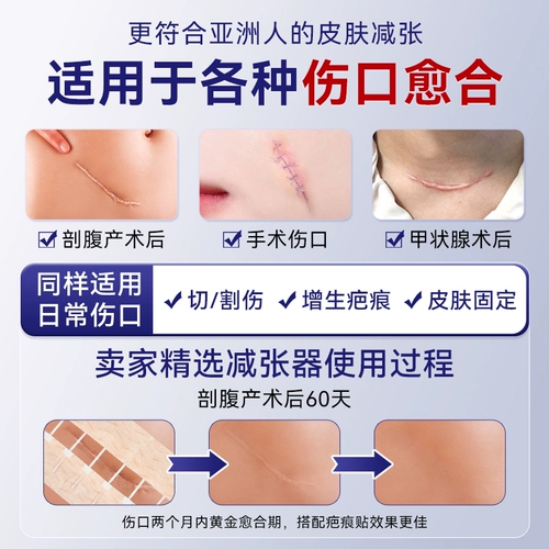 Уменьшите шрамы по размещению размещения для кесарева сечения.