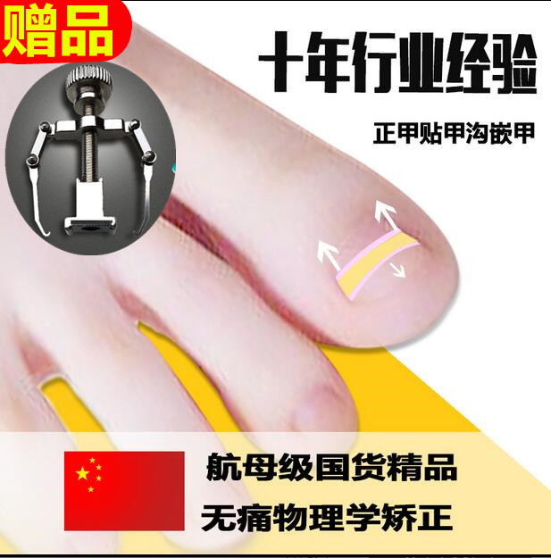包邮嵌甲矫正器卷甲修脚工具甲沟专用钳脚趾甲疼正甲贴指甲内嵌炎
