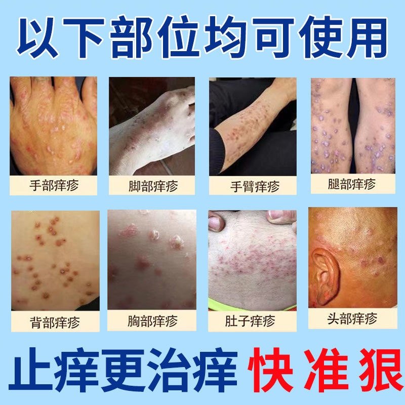 结节性痒疹特效药膏，祛除顽固性结节硬疙瘩的秘密武器？-小宠医疗用品-淘宝好物网