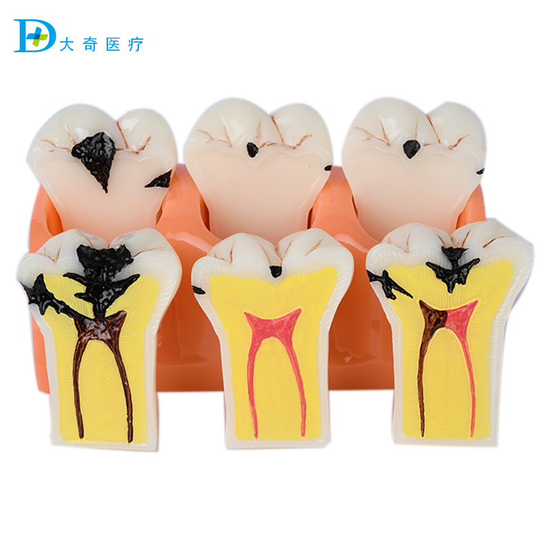 Dental oral teaching model divided into half jewelry to explain communication ornaments large dental dentist material tooth decay mold