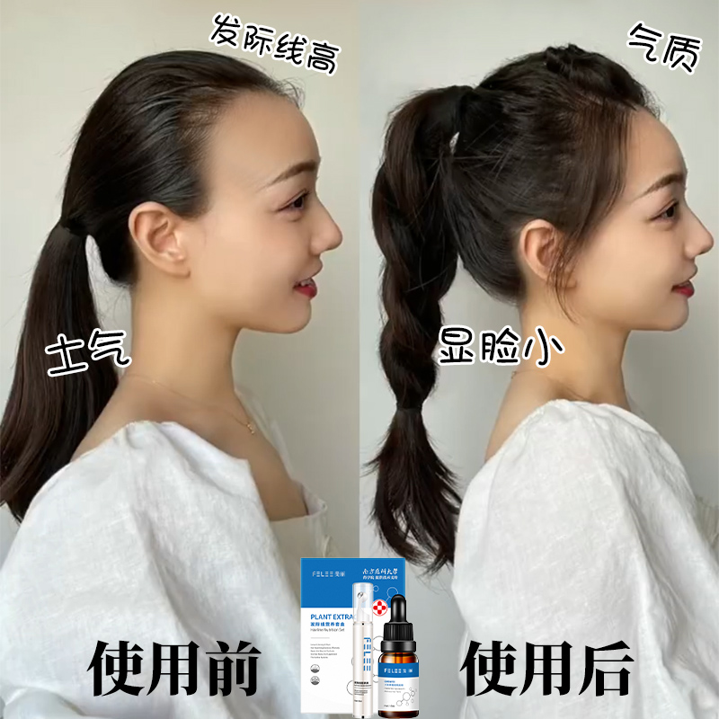 (Recommended by Li Jiaqi, buy 2 get 1 free) Say goodbye to the big forehead artifact, don't go bald, hairline nutrient solution