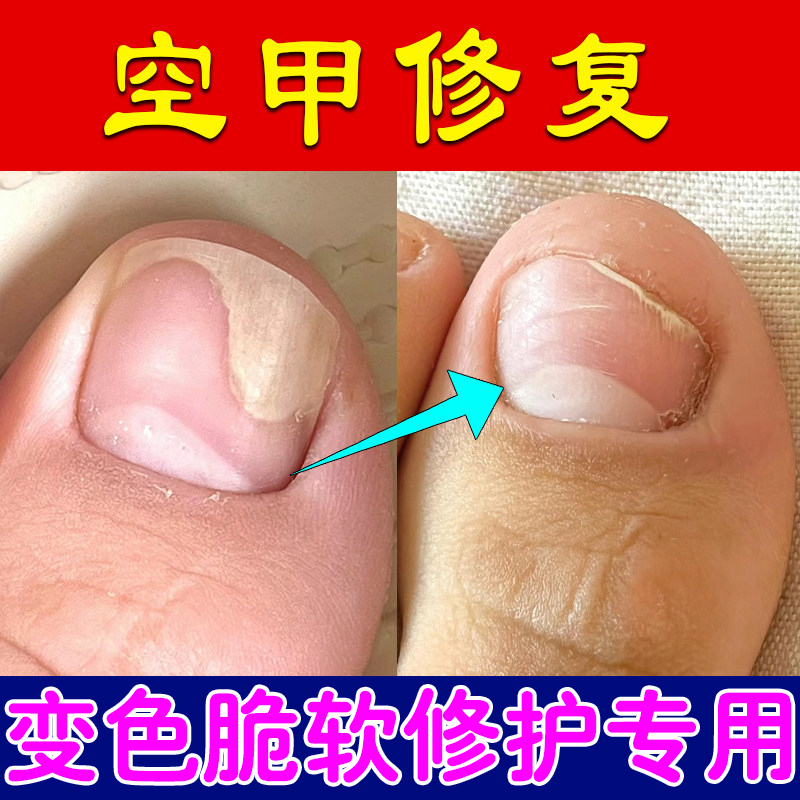 Treatment Solution for Separated Nail Beds and Hollow Nails, Specialized for Damaged Nails, Layered Vertical Lines, Peeling, Uneven Surfaces