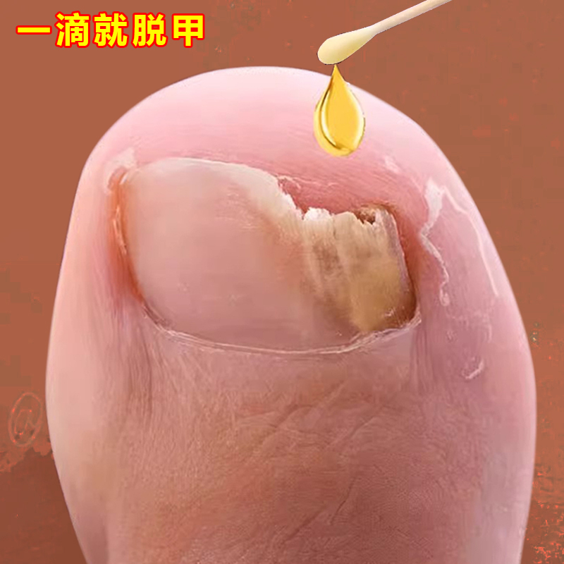 Fungal White Toenails Become Thick, Yellow, White, and Gray, and the Nail Bed Becomes Separated and the Nail Becomes Hollow. Specialized Nail Repair Medicine Fungal White Toenails Become Thick, Yellow, White, and Gray, and the Nail Bed Becomes Separated and the Nail Becomes Hollow. Specialized Nail Repair Medicine