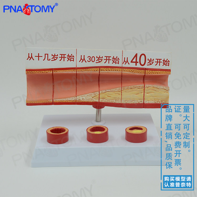 人体动脉血管堵塞模型心脑血管血栓/硬化模型医用心脑血管科
