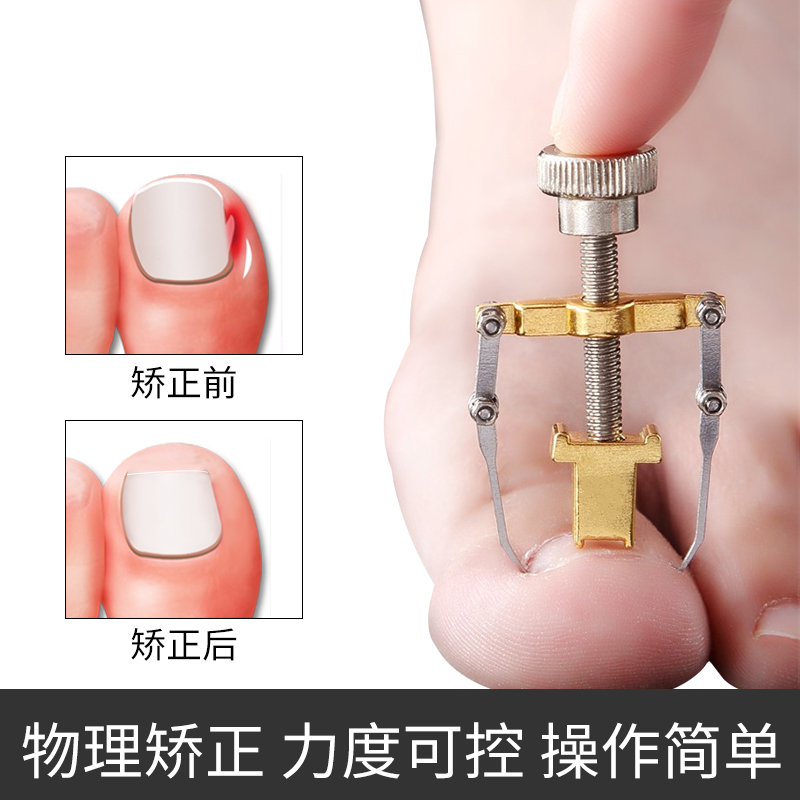 Toenail corrector corrects long flesh toenail corrects embedded hook foot groove inflammation Positive armor artifact Nail groove embedded armor