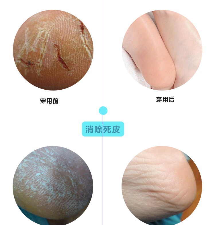 Chính hãng Ziyan bẻ khóa vớ nam loại vớ cao gót nam vớ mùa hè mỏng phần chống nứt chân hiệu ứng đặc biệt vớ nike cổ cao