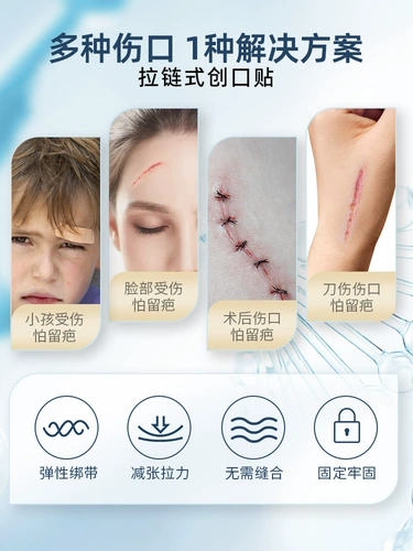 Тензор кожи шрам, свободный от шить