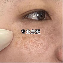 No scabs spot spots wherever there is dirt remove black spots on face spots lighten and remove black spots take 2 shots and 3