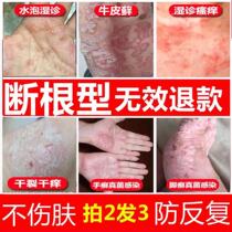 Special treatment of skin diseases ringworm of the hands blisters eczema fungal infection anti-itching root removal cowhide athletes foot athletes foot moss ointment