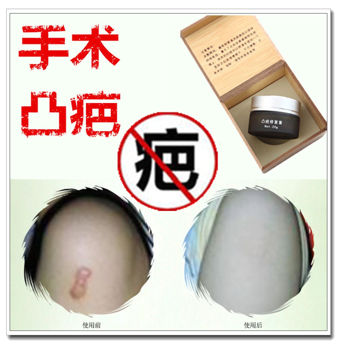Go to the face, scar print, planing, abdominal birth injury, scar spirit, repair, flat, medical surgery, hyperplasia, antipruritic, softening paste