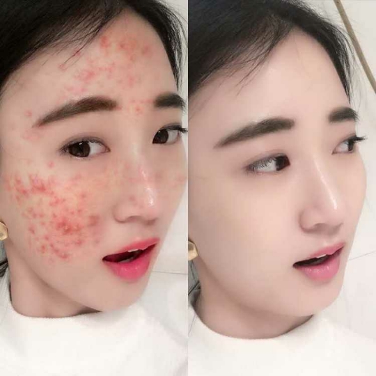 30 lá lúa gạo hydrating bó mụn trứng cá in mật khẩu nam và nữ để mụn đầu đen mùa đông mặt nạ se khít lỗ chân lông