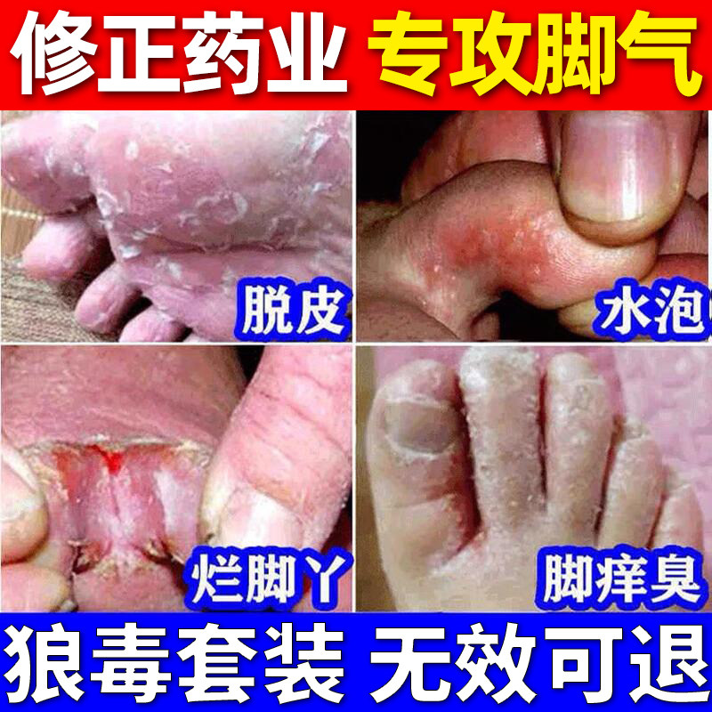 Foot gas anti-itching water bubble peeling to rotten foot girl Rotten Smelter Root Fungus Dry Cracked Leather Ointment Type