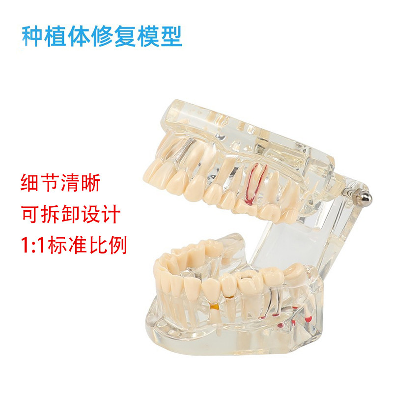 牙齿模型 牙科正畸种植体修复模型 口腔教学医患沟通齿科透明牙模