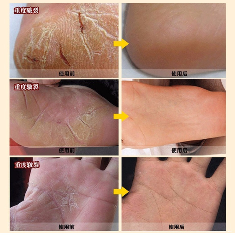 [Mua hai tặng một miễn phí] Nhật Bản Wei Xianger Hokkaido ngựa dầu rõ ràng kem bôi bàn tay chống ngứa kem thối mắt cá chân kem chăm sóc kem got chan