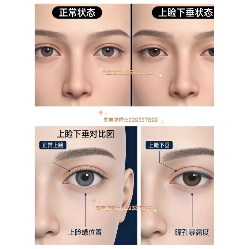 Cfs Upper Eyelid Drooping Collection, Eyelid Edge Incision, Cfs Correction, Fascia Suspension Method, Practical Tutorial on Severe Upper Eyelid Drooping