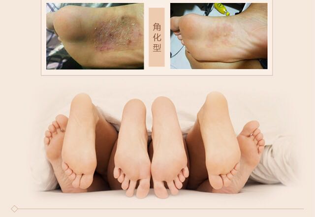 Nhật bản dầu ngựa rõ ràng kem chân Wei Xianger Hokkaido dầu ngựa ngứa kem thối chân 丫 chăm sóc bàn chân kem chính hãng kem làm mềm gót chân