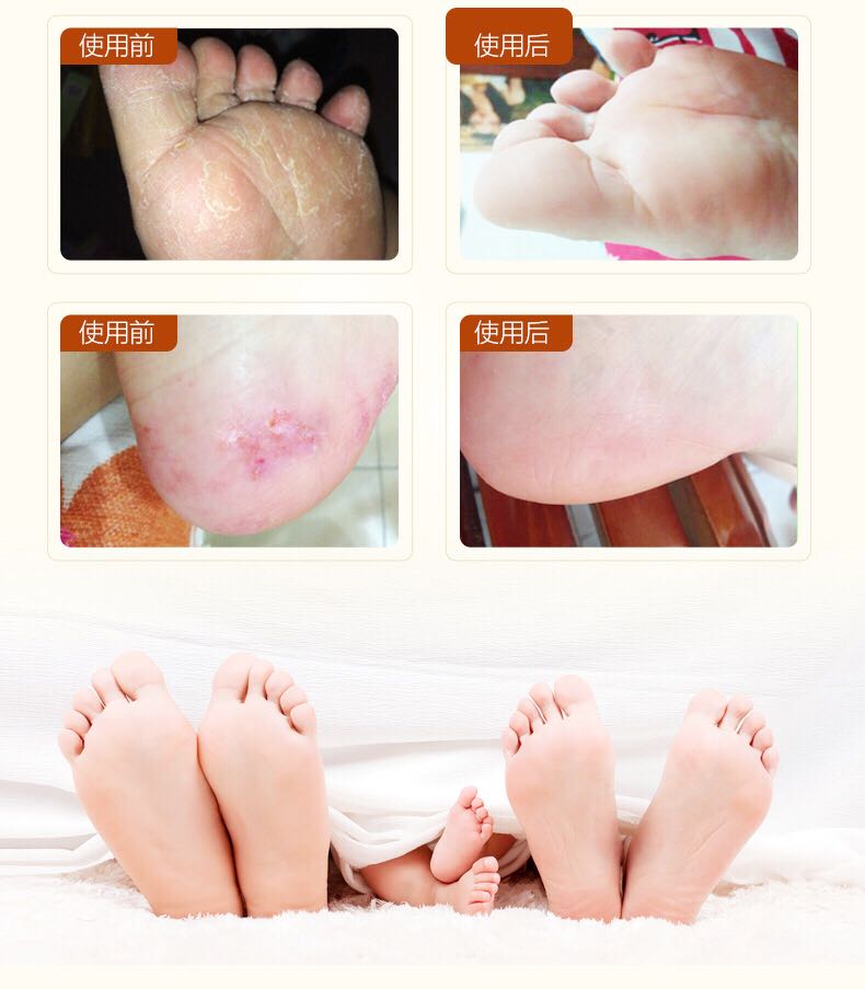 Kem dưỡng da chân ngựa Nhật Bản rõ ràng Kem chống ngứa Kem chăm sóc chân Napaiya Kem bôi chân rõ ràng chính hãng mua 3 tặng 2 ủ lột da chân