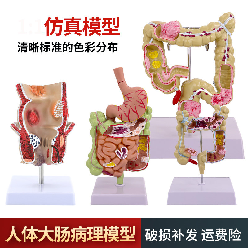 大肠病理模型 直肠 大肠 肠胃病变解剖 人体肠道疾病结肠病变模型