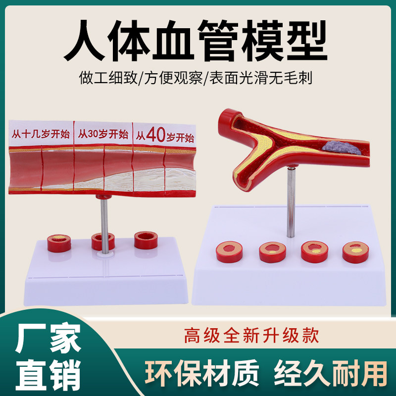 人体支脉粥样堵塞心血管模型血栓血液浓度脂肪病理粥样硬化解剖