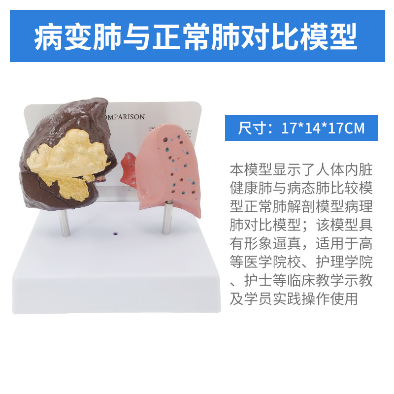 肺模型 肺结构模具 吸烟危害健康吸烟肺呼吸系统 病理肺解剖模型