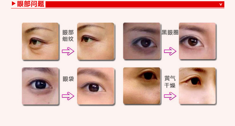 Huixiangfang kem mắt để nếp nhăn làm săn chắc chất khô dòng hydrating nâng chăm sóc mắt kem trị thâm mắt kumargic