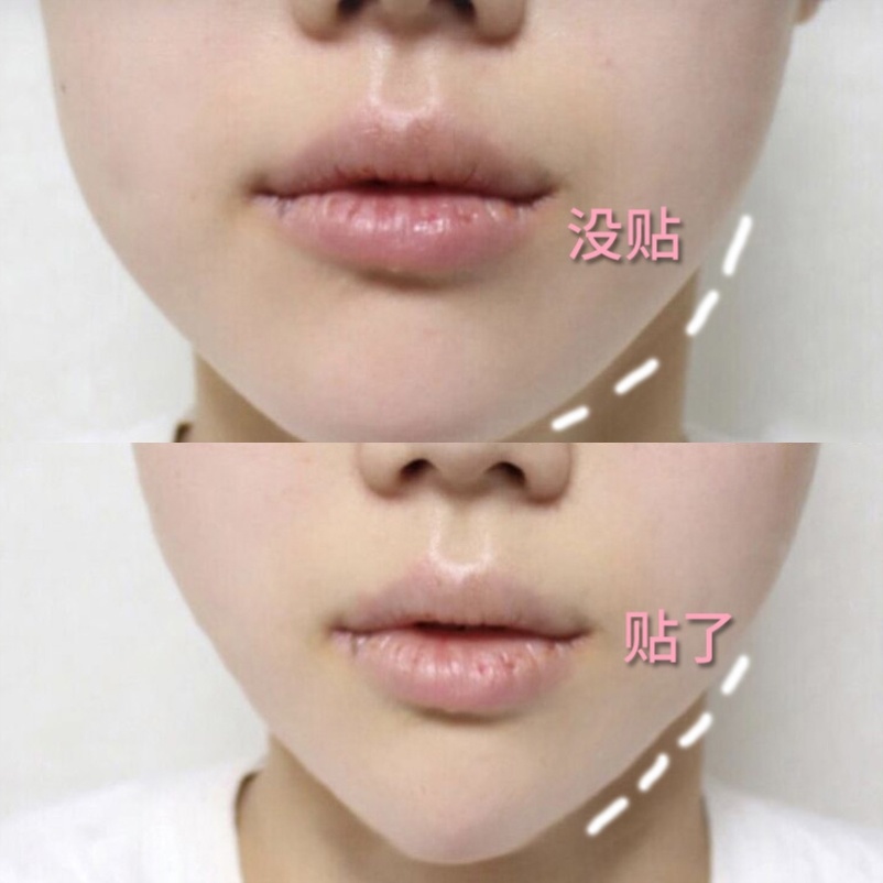 Slim face with hidden tape facial pull artificial net red bite muscle small face tight melon face