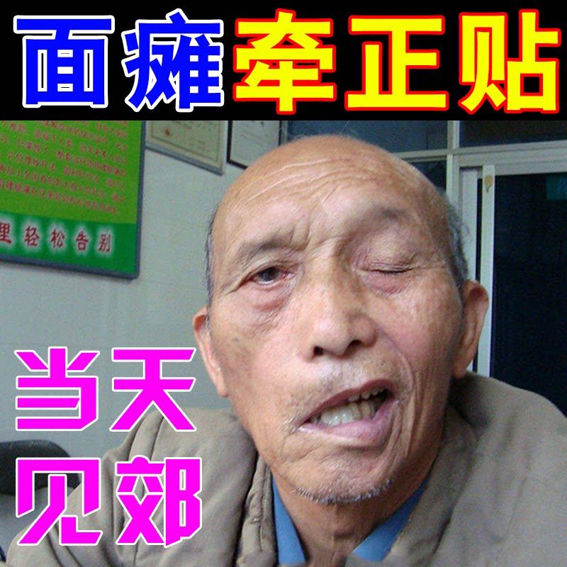 Facial paralysis special medicine pulls the paste paste smelting hanging line wind facial paralysis sequelae stiff spasm mouth crooked eyes slanted recovery artifact