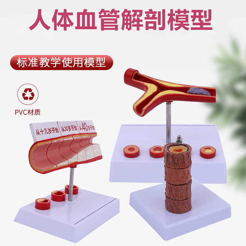 人体血管模型 粥样动脉/硬化模型 病变血栓/血管/病演示血管模型
